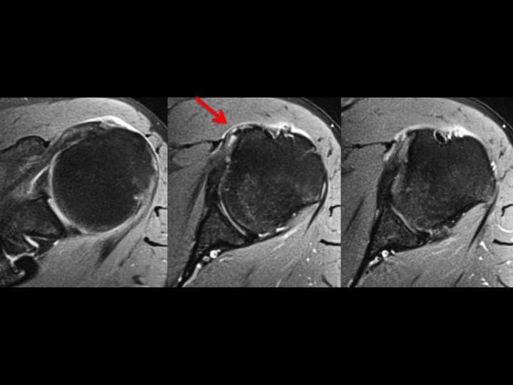 Figure 2 for case calcium hydroxyapatite crystal deposition disease ( RID3594 )